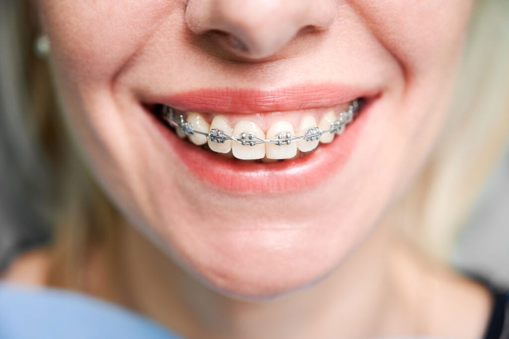 Ankara Ortodonti, Ankara Ortodonti Uzmanı, Ankara Ortodonti Doktoru, Ankara Ortodonti Doktorları, Ankara Ortodontist, Ankara Diş Teli, Ankara Şeffaf Plak, Anka invisalign